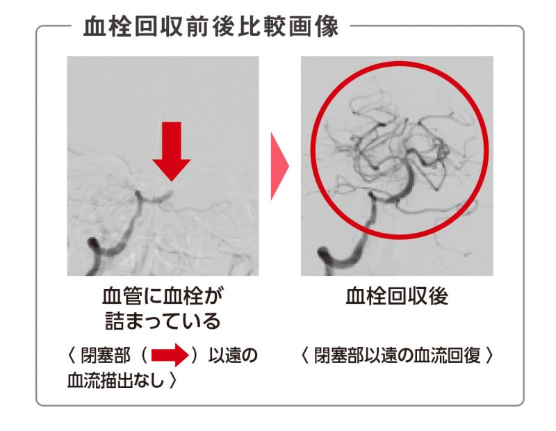 軽い 脳 梗塞 症状